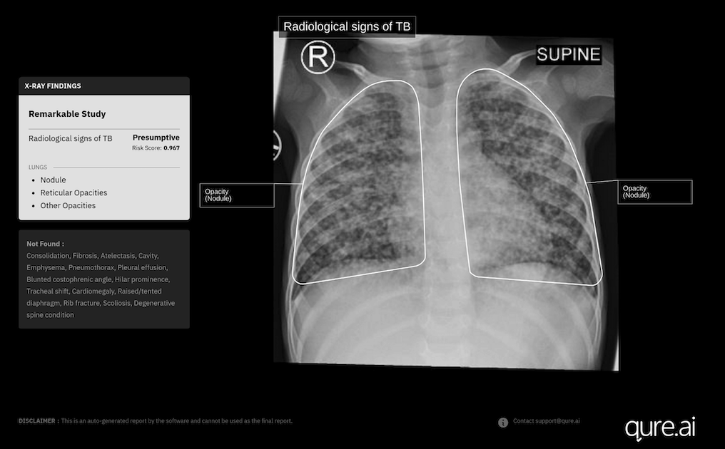 Paediatric chest X-ray scan analysis
